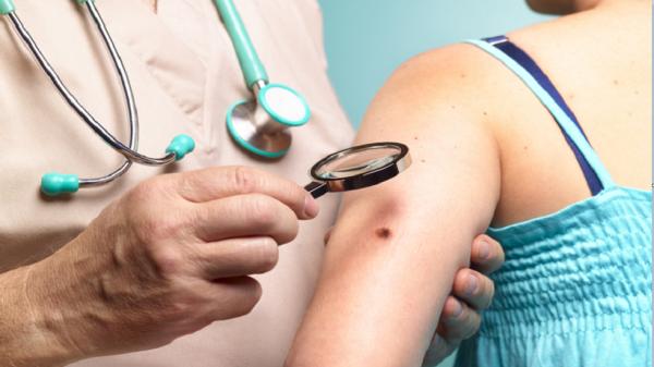 علاج جديد لأخطر أشكال سرطان الجلد يقلل من خطر عودة المرض والوفاة إلى النصف