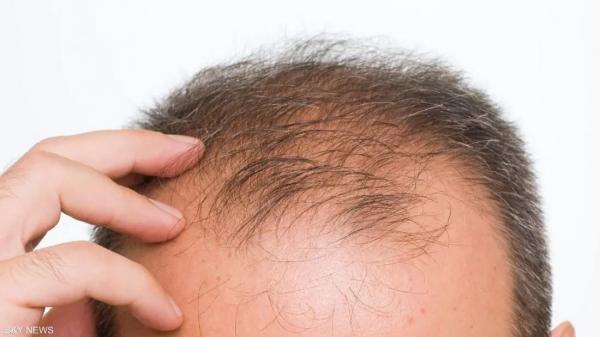 دراسة: هذه المشروبات تؤدي إلى تساقط الشعر عند الرجال