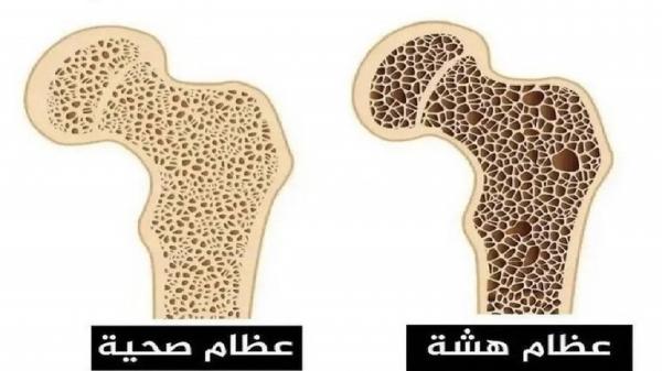 طرق الوقاية من هشاشة العظام