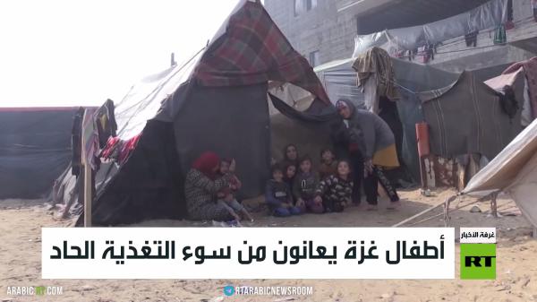 أطفال غزة يعانون من سوء تغذية الحاد