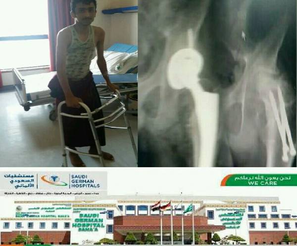 يمني يتحرك بزراعة مفصل في السعودي الألماني بعد سنوات من الشلل 