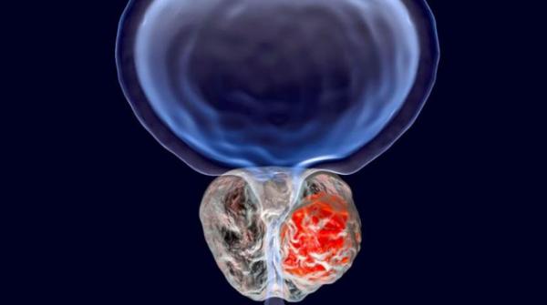 علاج ثلاثي «مذهل» لسرطان البروستاتا