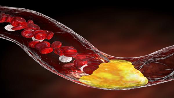 "الألم الشديد" قد يكون علامة تحذيرية لارتفاع مستويات الكوليسترول في الدم!