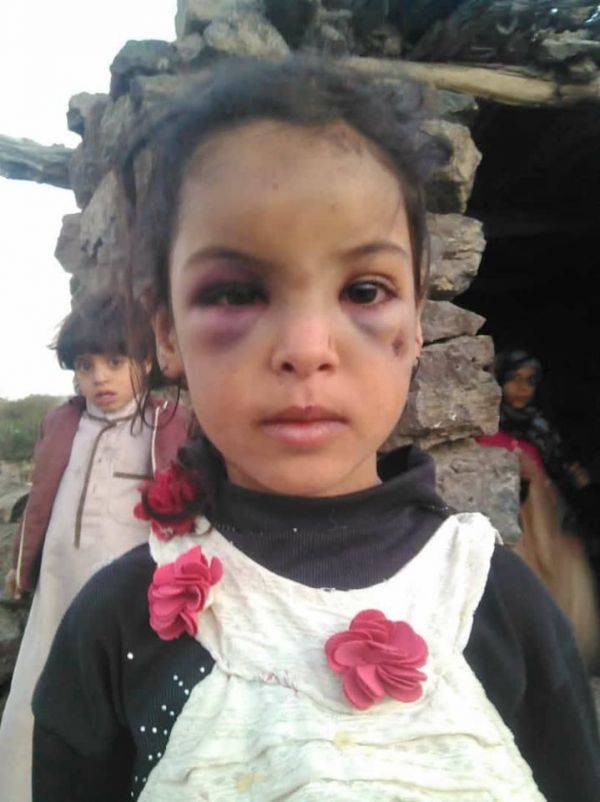 ضرب وحشي وتعذيب بالنار.. أب حوثي يذيق ابنته اصناف العذاب! (تعرف على السبب)