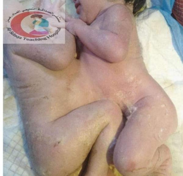 في عملية نادرة.. مستشفى الصداقة بعدن ينجح في إجراء عملية قيصرية لتوأم ملتصق