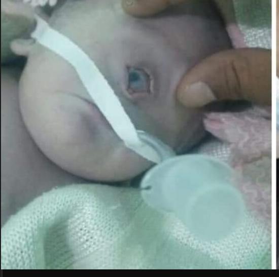 6 حالات على مستوى العالم خلال 5 قرون ولادة طفل بعين واحدة في رداع بالبيضاء