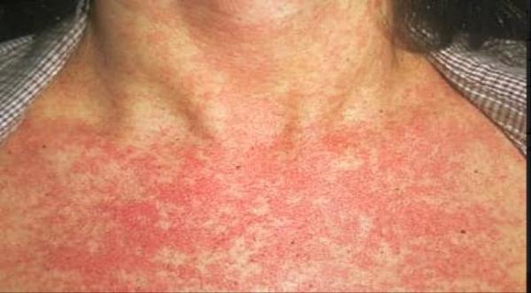 "الصحة العالمية": 34 حالة وفاة وأكثر من 200 حالة إصابة بمرض الحصبة في اليمن 