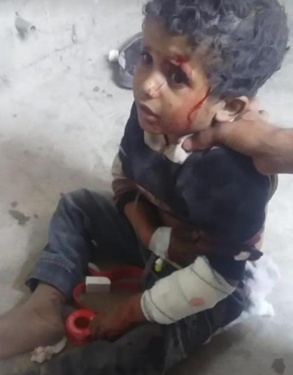 لغم حوثي يستهدف طفل في كرش