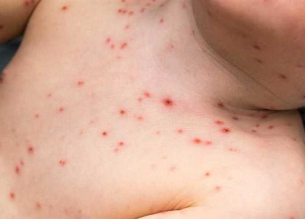 بينها الحصبة والدفتيريا.. أمراض قاتلة تعود إلى مناطق عصابة الحوثي بعد منعها للقاحات 