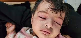 بسبب الحوثي .. زيادة في الوفيات و ارقام مخيفة لانتشار الحصبة في اليمن