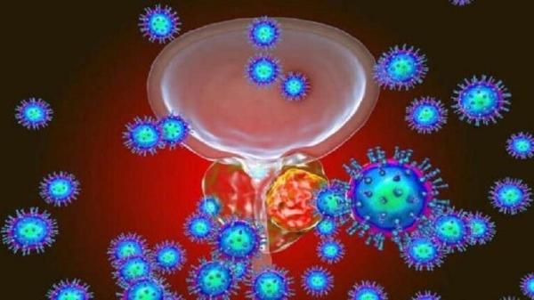 "علاج إشعاعي" لمدة 5 أيام يمكن أن "يعالج' سرطانات البروستات العالية الخطورة أسرع من المعتاد!