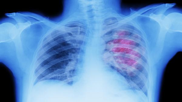 فيروسات قديمة مختبئة في الحمض النووي قد تكون مفتاح علاج سرطان الرئة