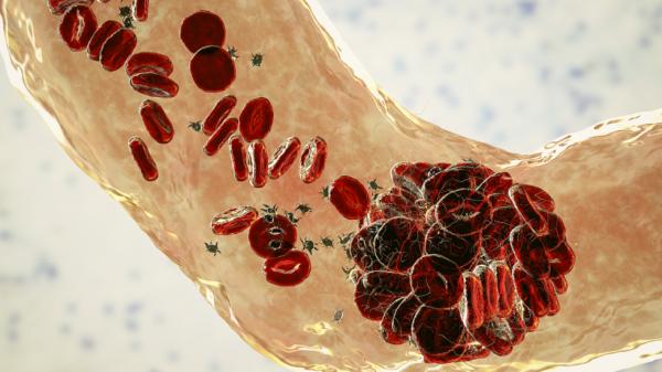 علامات "تحذيرية شائعة' لجلطات الدم!