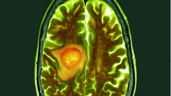 "اكتشاف هام" يمكنه القضاء على سرطان الدماغ لدى الفئران!