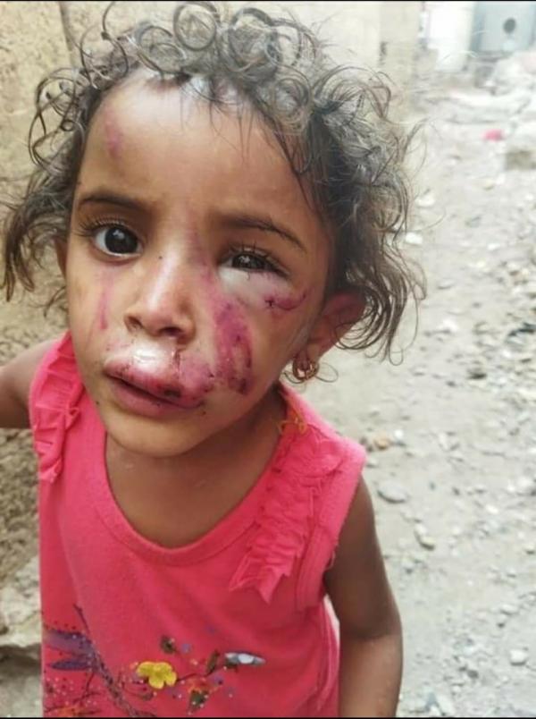 تعز.. جريمة يندى لها الجبين بحق طفلة لم تتجاوز الرابعة