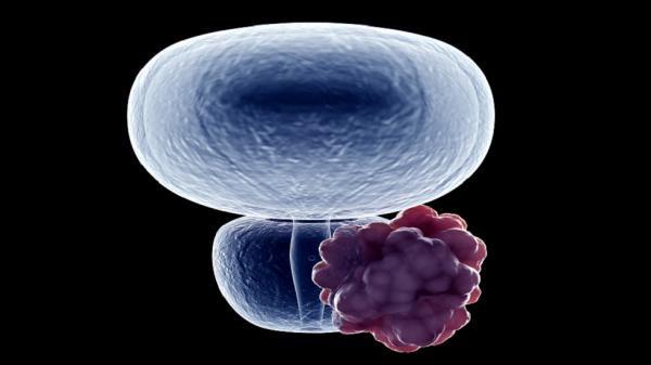 تحذير للرجال من خطر يولد سرطان البروستات"