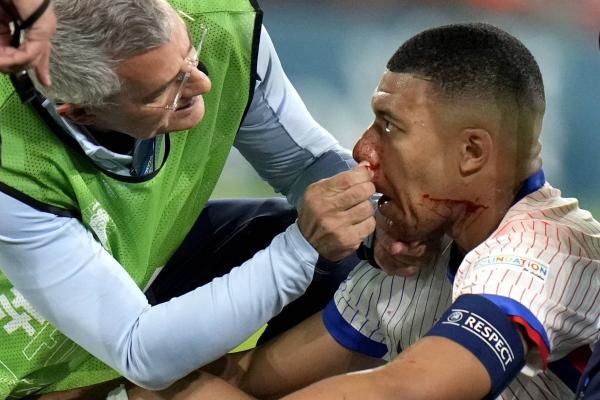مبابي… سوء الحظ يتواصل في كأس أوروبا بـ«صفراء» ووجه دامٍ
