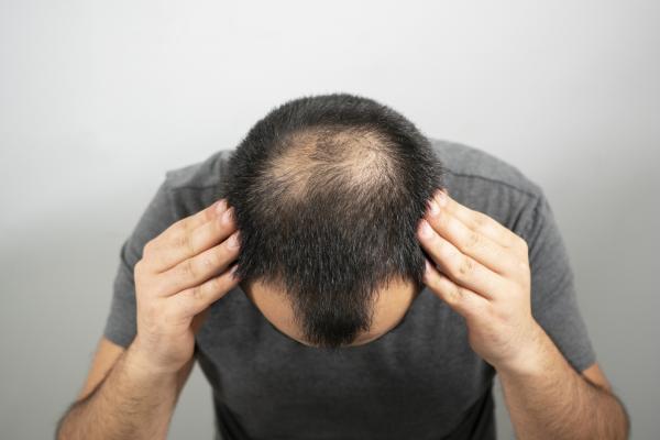 اكتشاف السبب "الدقيق" لتساقط الشعر ما يعد بعلاجات جديدة للصلع