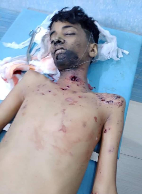 الطفل حمزة الغرياني يلقى حتفه بلغم حوثي مموها بالجحملية
