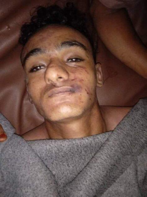 متحوث يقتل طفل طعن في المراوعة ولغم حوثي يبتر ساق مواطن بالدريهمي