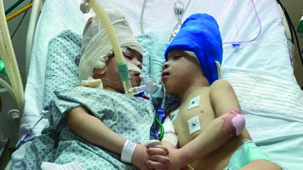 استخدام الواقع الافتراضي في عملية فصل توأمين