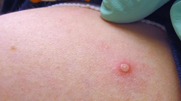 أميركا تعلن جدري القردة حالة طوارئ صحية عامة