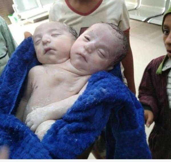 وفاة  طفل برأسين بعد ساعات من ولادته في زبيد