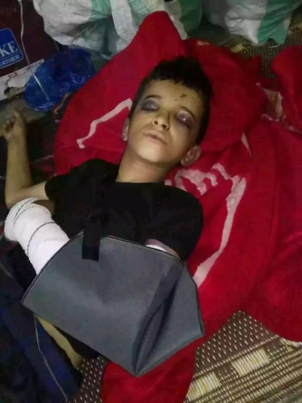 تعرض طفل للتعذيب بشكل وحشي في حريب مأرب 