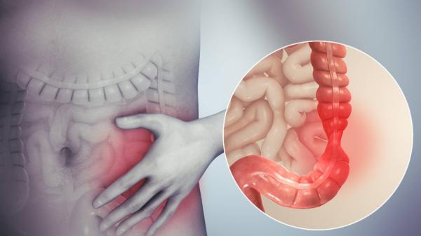 6 أطعمة تجعل قولونك العصبي في حالة «أسوأ»