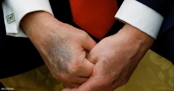 مخاوف صحية حول ترامب بعد ظهور كدمة داكنة جديدة على يده