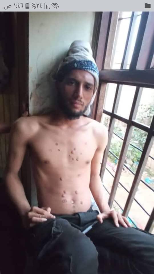 تعذيب سجين بأعقاب السجائر في التربة بتعز 