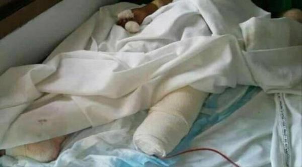 لغم حوثي يتسبب ببتر قدمي طفلة في ريف تعز الغربي