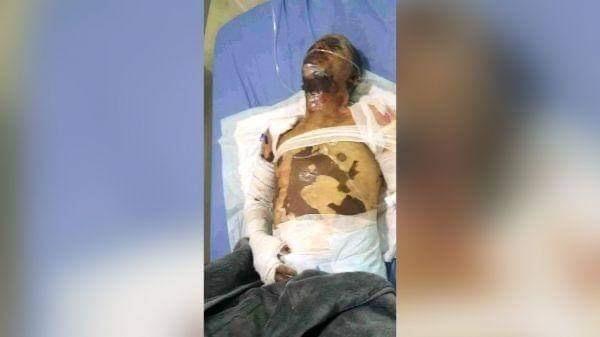 إب.. وفاة "بائع الآيسكريم" بعد أسبوع من إشعاله النار في جسده بسبب عدم حصوله على أسطوانة غاز