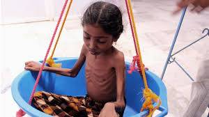 تقرير أممي: اليمن ستكون الأفقر في العالم حال إستمرار الحرب..!؟