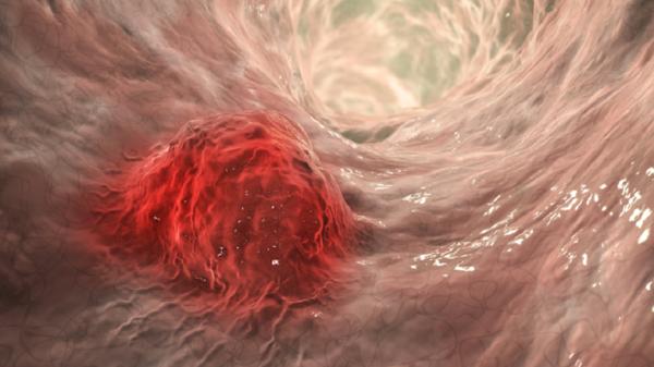 أربعة تغييرات في نمط الحياة توفر "أفضل أمل" لتقليل خطر الإصابة بالسرطان