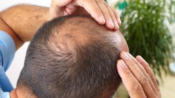 علاج محتمل للصلع.. علماء يطورون شعرة في مختبر