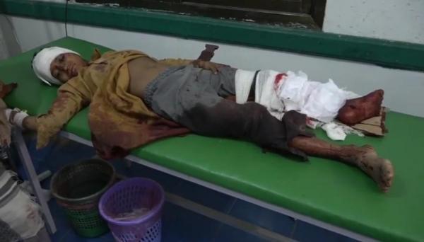 قذيفة حوثية تصيب ثلاثة أطفال من أسرة واحدة في تعز