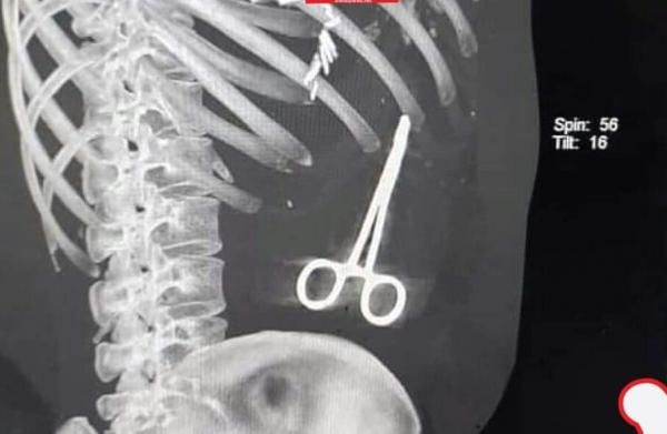 اكتشاف مفاجئ داخل بطن جريح عاد من رحلة علاجية خارج اليمن -(شاهد الصورة)