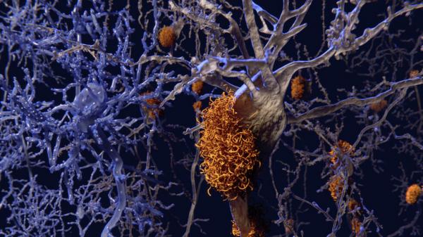 عقار ألزهايمر "الواعد" يفشل في تحقيق هدفه ويبدد آمال العلماء في علاج المرض المميت