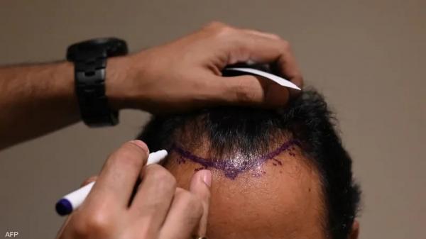 شاب هندي يدفع حياته ثمنا لـ"عملية زرع شعر"