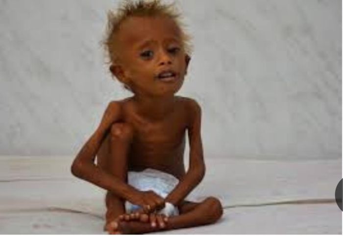 مرض غريب ينتشر في الحديدة يهاجم الأطفال ويتسبب في وفاتهم