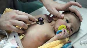 وفاة الأطفال حديثو الولادة بمستشفيات مناطق الحوثي والسبب التلوث