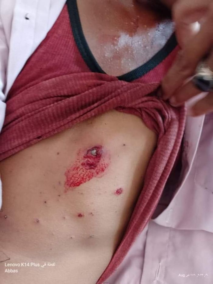 إصابة طفل برصاص قناص عصابة الحوثي غرب تعز