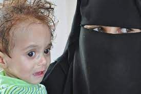 تفاقم مشكلة سوء التغذية بنسبة 60% في عمران