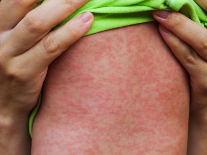 بسبب سياسة الحوثيين .. وفاة 342 طفلاً يمنيًا بمرض الحصبة خلال 6 أشهر