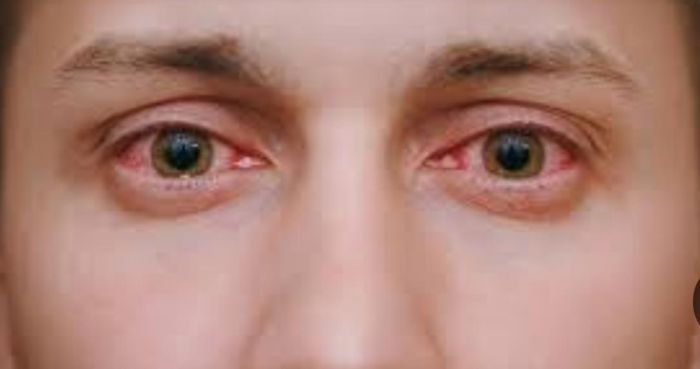 تفشي "رمد العيون" بمحافظة لحج بعد انتقاله من عدن