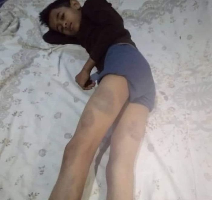  مدير مدرسة في اب يعتدي بالضرب على طفل يتيم
