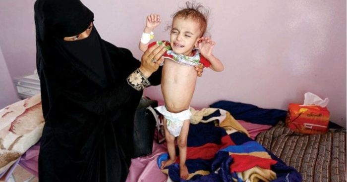 حالات مرضية أكثر من الضعف في مناطق سيطرة العصابة الحوثية الإيرانية بتعز وإب