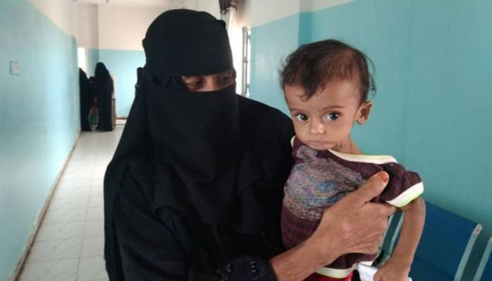 الحوثيون يقرون باستفحال سوء تغذية الأطفال في مناطقهم