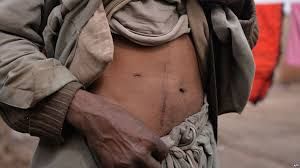 عصابة الحوثي تتاجر بأعضاء مقاتليها مع وسطاء عرب ودوليين